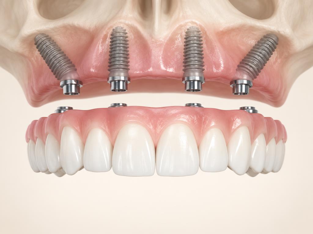 All-on-4 and All-on-X fixed full arch